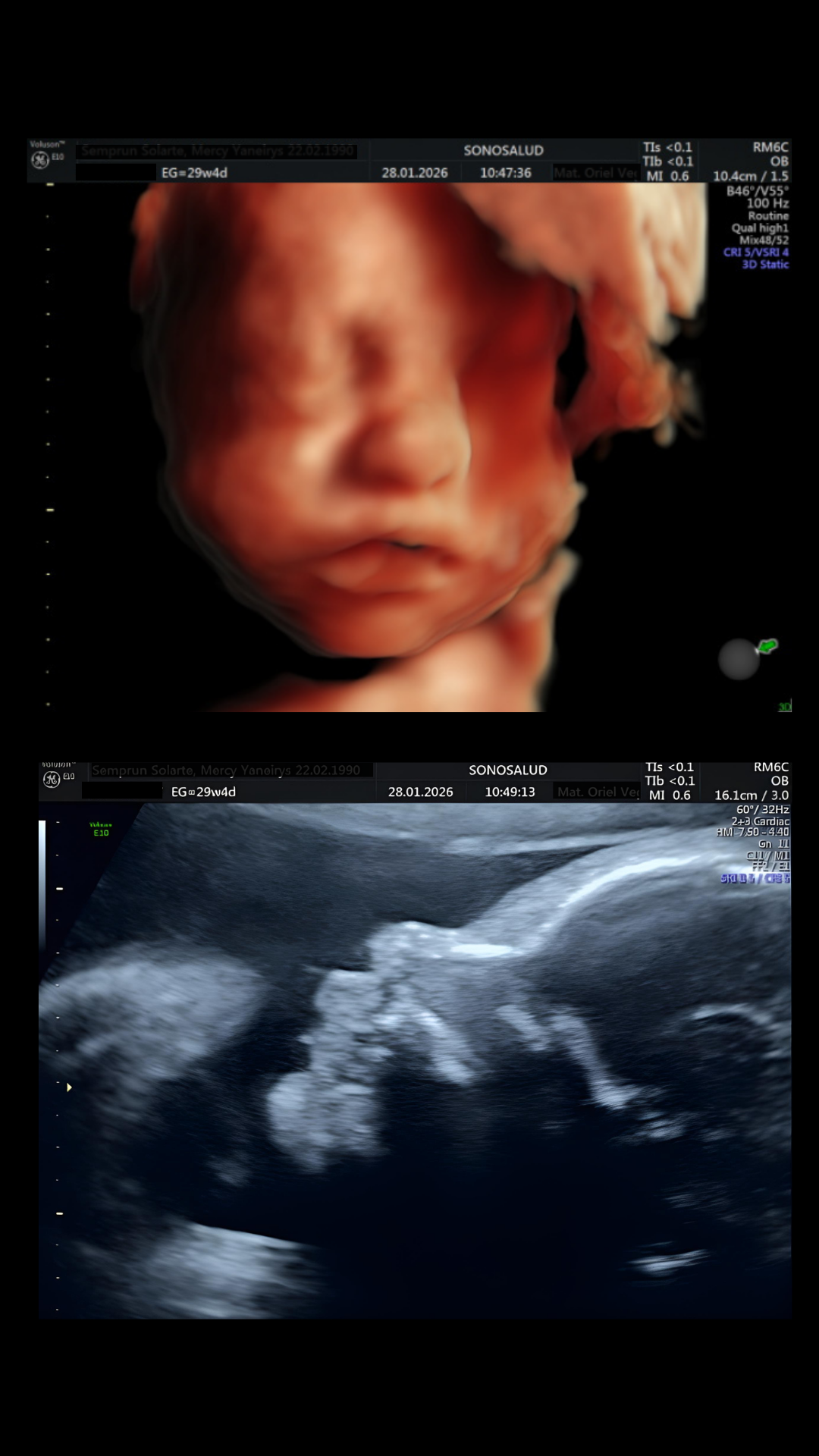 Ecografía 2D y 5D del mismo bebé en SonoSalud