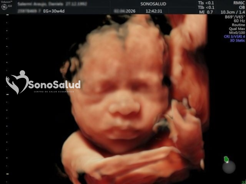 Ecografía 3er Trimestre